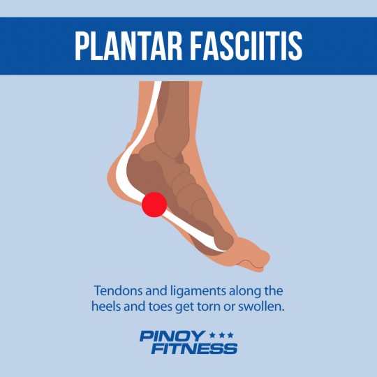 plantar fasciitis