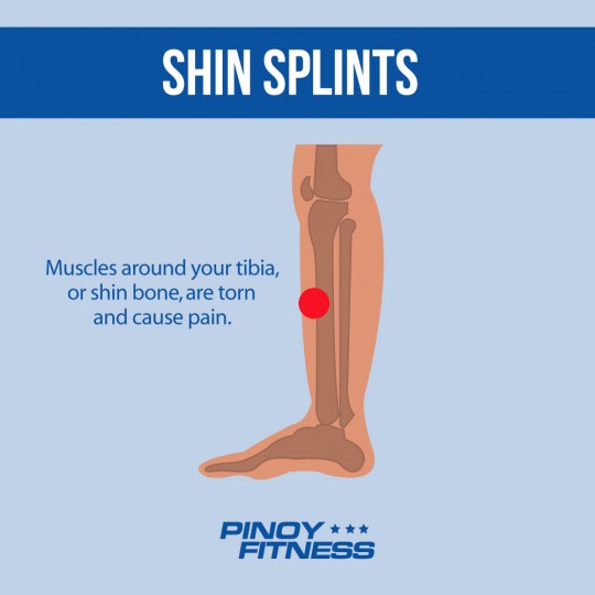 shin splints